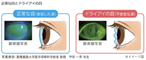 フルオセイン染色ドライアイ