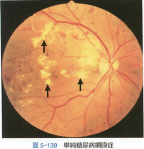 単純糖尿病網膜症