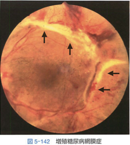 増殖糖尿病網膜症（線維血管組織（矢印））